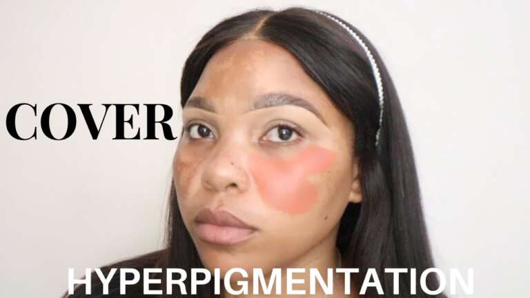 Natural Approaches to Correcting Hyperpigmentation & Melasma